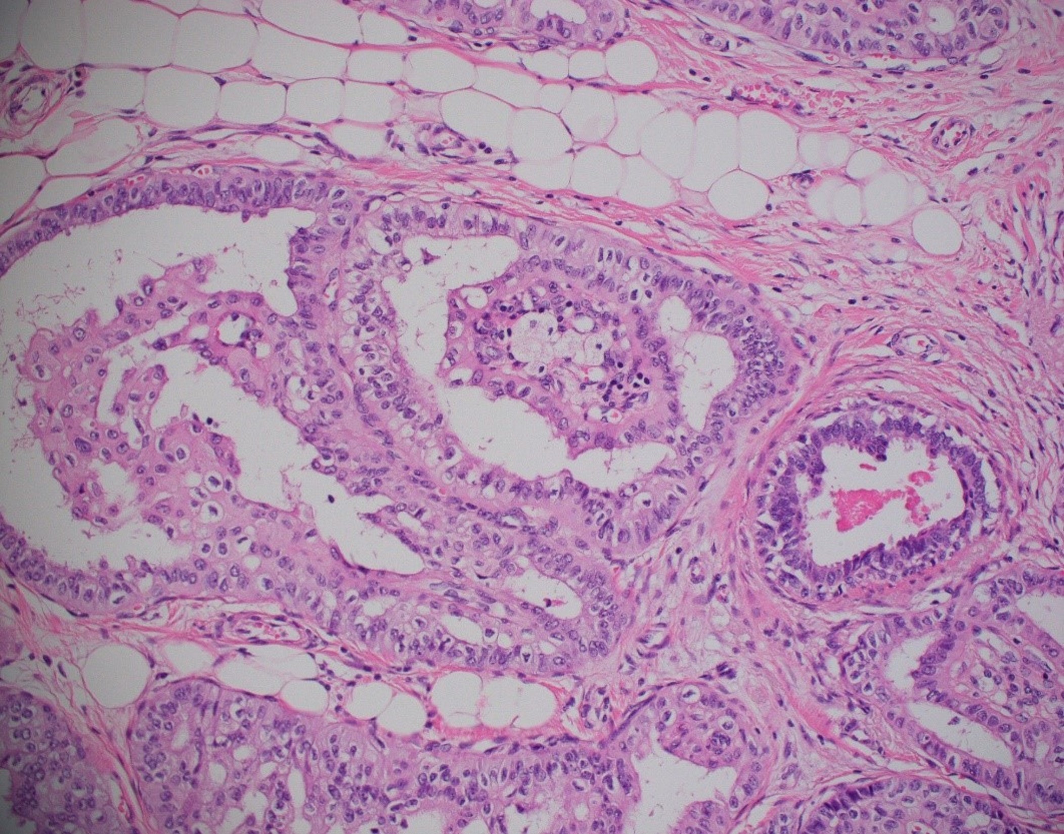 Tall Cell Carcinoma with Reversed Polarity Evin G picture Aug 2023.jpg