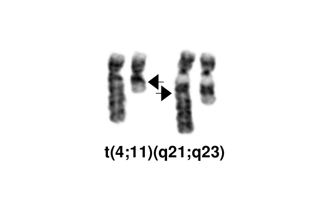 Translocation T 4 11 Q21 Q23 Compendium Of Cancer Genome Aberrations