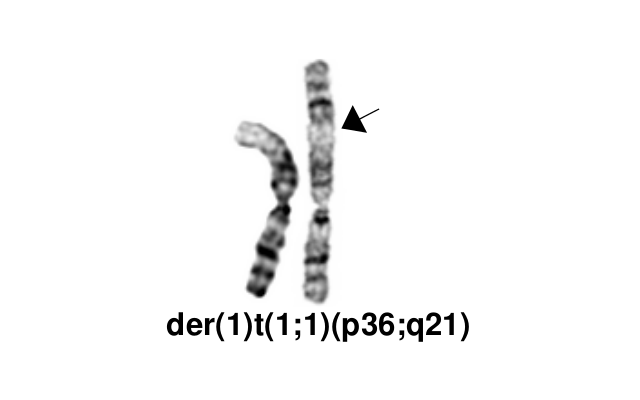 der(1)t(1;1)(p36;q21)