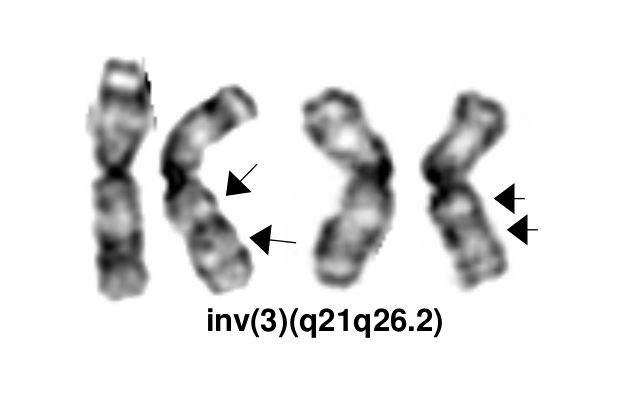 Acute Myeloid Leukemia (AML) with inv(3)(q21.3q26.2) or t(3;3)(q21.3