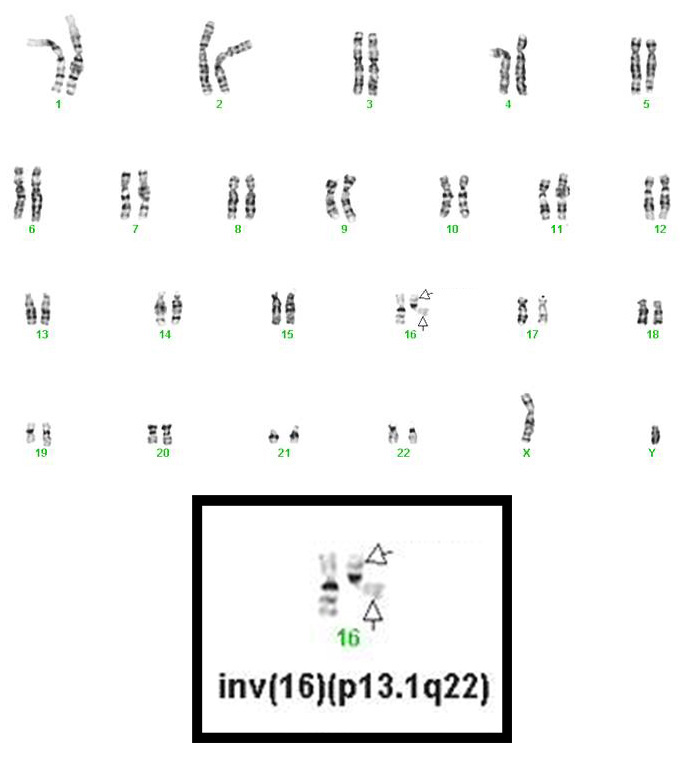 Acute Myeloid Leukemia (AML) with inv(16)(p13.1q22) or t(16;16)(p13.1